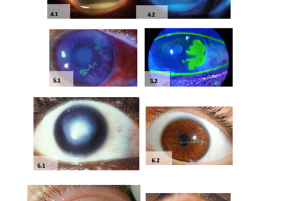 Collection of photos of Eyes showing different issues