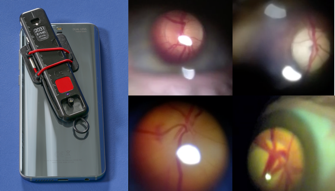 Direct Ophthalmoscopy and Arclight